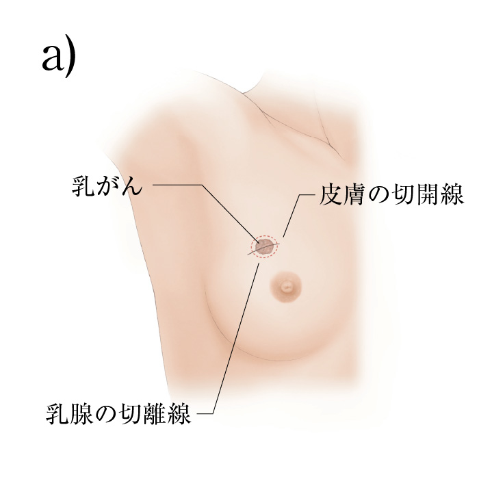 Amazon.co.jp: 乳房オンコプラスティック・サージャリー: 症例