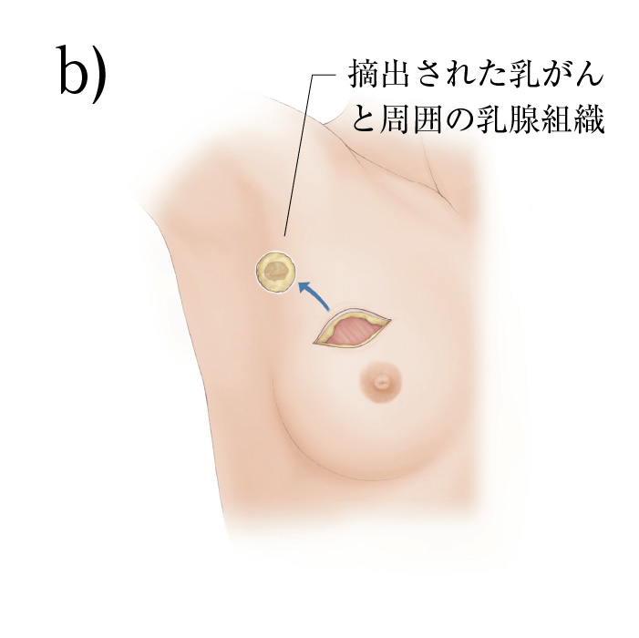 整容性からみた乳房温存治療ハンドブック 整容性からみた乳房温存治療ハンドブック | 矢形 寛, 矢形 寛