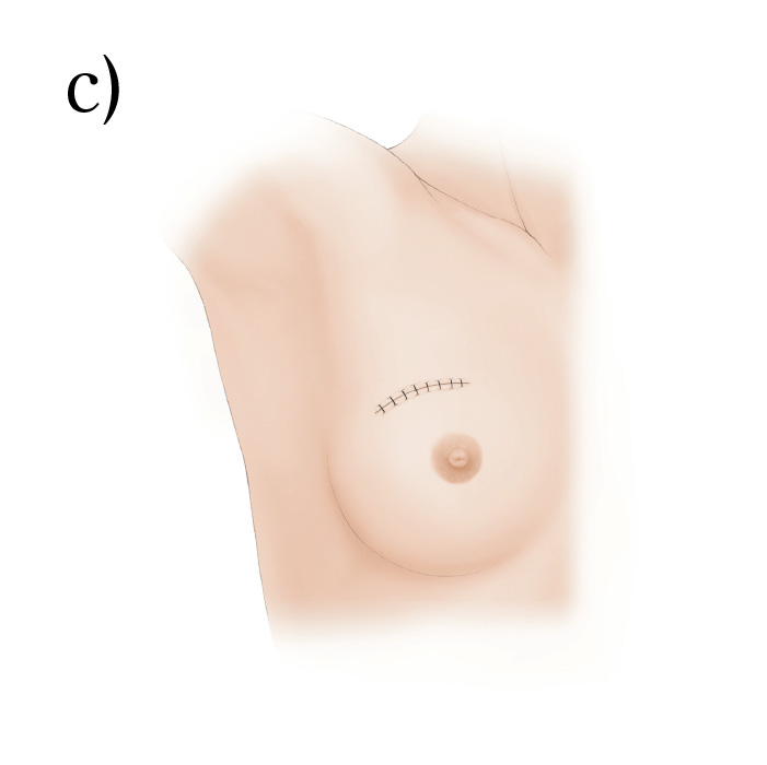 乳房オンコプラスティック・サージャリー2 症例から学ぶ手術手技 Amazon.co.jp: 乳房オンコプラスティック・サージャリー: 症例