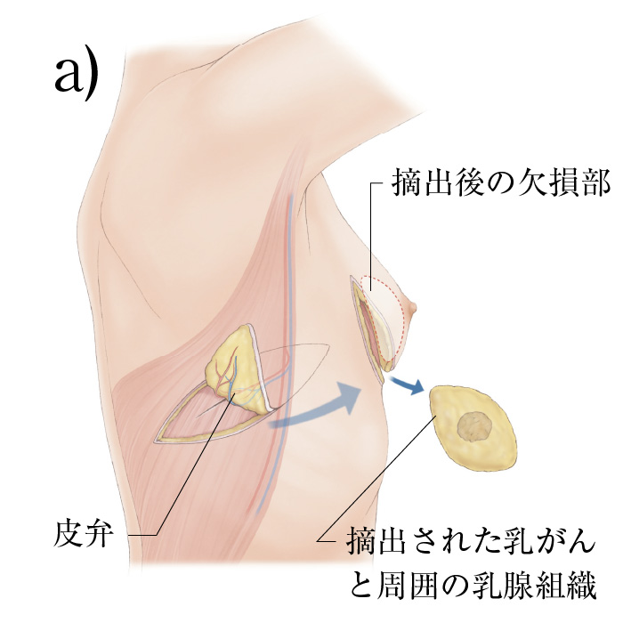 乳房温存療法について｜一般社団法人日本乳房オンコ