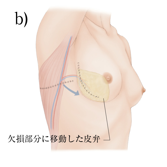 乳房温存療法について｜一般社団法人日本乳房オンコ