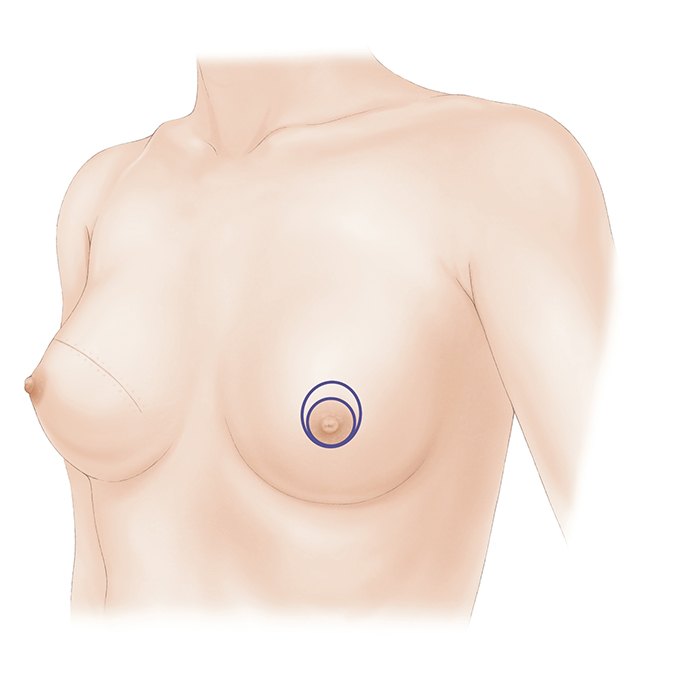 乳房オンコプラスティック・サージャリー2 症例から学ぶ手術手技 Amazon.co.jp: 乳房オンコプラスティック・サージャリー: 症例