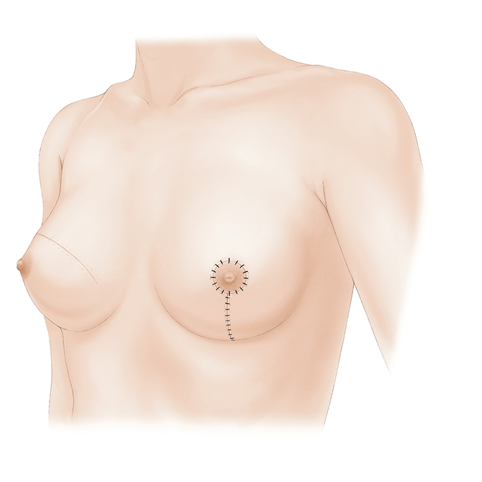 健側（反対側）の乳房手術について｜一般社団法人日本乳房オンコ