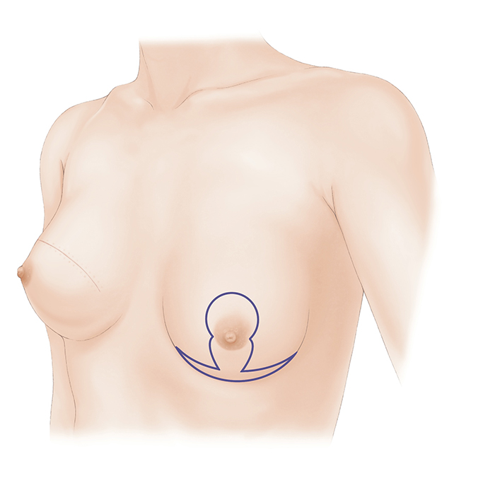 健側（反対側）の乳房手術について｜一般社団法人日本乳房オンコ