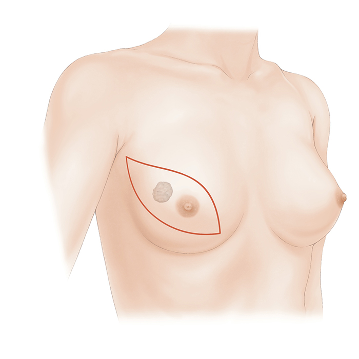 乳房全切除術について｜一般社団法人日本乳房オンコ