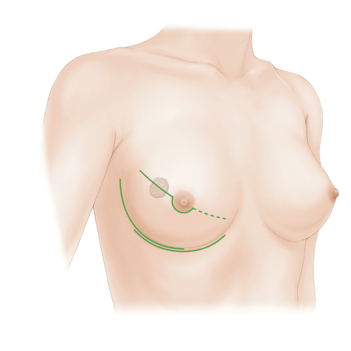 乳房全切除術について｜一般社団法人日本乳房オンコ