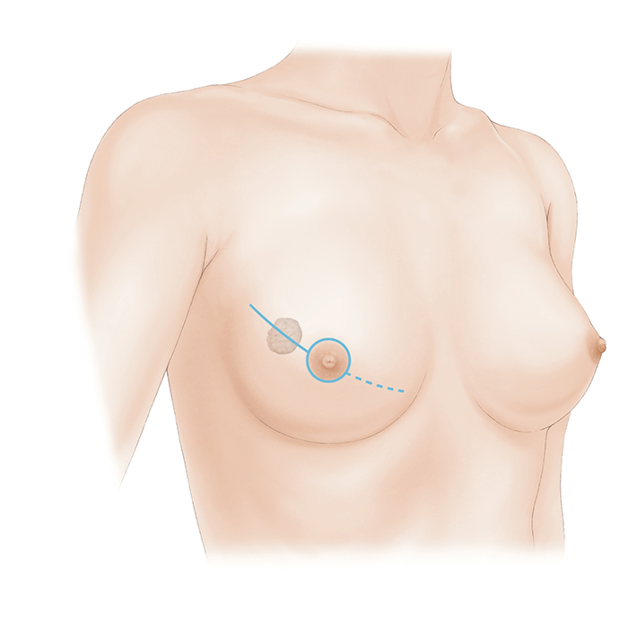 乳房全切除術について｜一般社団法人日本乳房オンコ