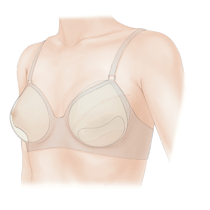 乳房オンコプラスティック・サージャリー2 症例から学ぶ手術手技 0421-744x1024.jpg
